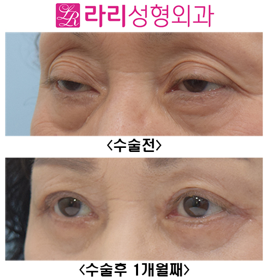 [Lari Plastic Surgery] Before and After Upper Blepharoplasty and Lower Blepharoplasty image 4