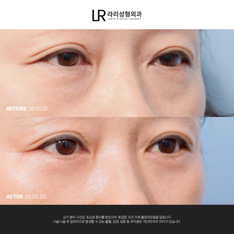 [라리성형외과] 눈 밑이 피곤해 보이는데 눈 밑에 지방만 빼면 될까?(눈밑지방재배치수술 VS 하안검수술) 관련 이미지 6