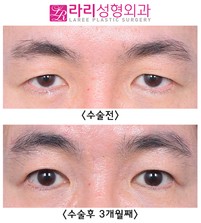 [라리성형외과] 함께해서 더 효과적인 상안검수술과 눈썹거상수술 전후 사진 관련 이미지 1