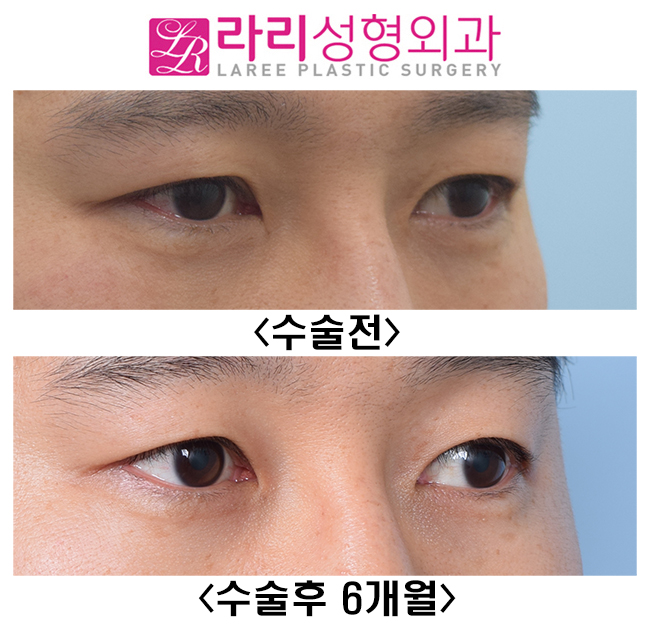 [라리성형외과] 눈을 떠도 눈을 감아도 쌍꺼풀이 없는 쌍꺼풀없애기 관련 이미지 4