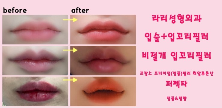 How to Make the Corners of the Mouth Lift Beautifully with Lip Corner Filler image 3