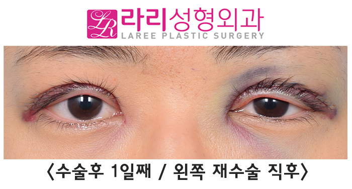 [라리성형외과] 겹주름 쌍꺼풀을 잘 없애려면 피할 수 없는 상안검외반, 좋아질 수 있어요. 관련 이미지 3