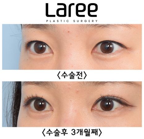 [Lari Plastic Surgery] A Collection of Various Surgeries for Double Eyelids image 4