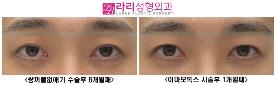 [Lari Plastic Surgery] Should You Get Forehead Botox Before Eye Surgery? image 3