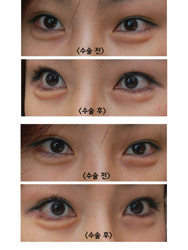 눈꼬리내리기뒤트임 장기경과 전후사진 관련 이미지 2