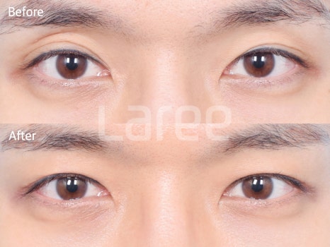 [Lari Plastic Surgery] Eyelid Fat Grafting for Improving the Eyelid Hollow: Incision Method vs. Non-Incision Method image 1