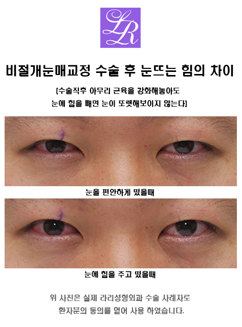 Why Does Non-Incisional Ptosis Correction Come Undone in Monolid Ptosis? image 4