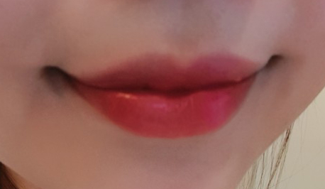 How to Make the Corners of the Mouth Lift Beautifully with Lip Corner Filler image 5