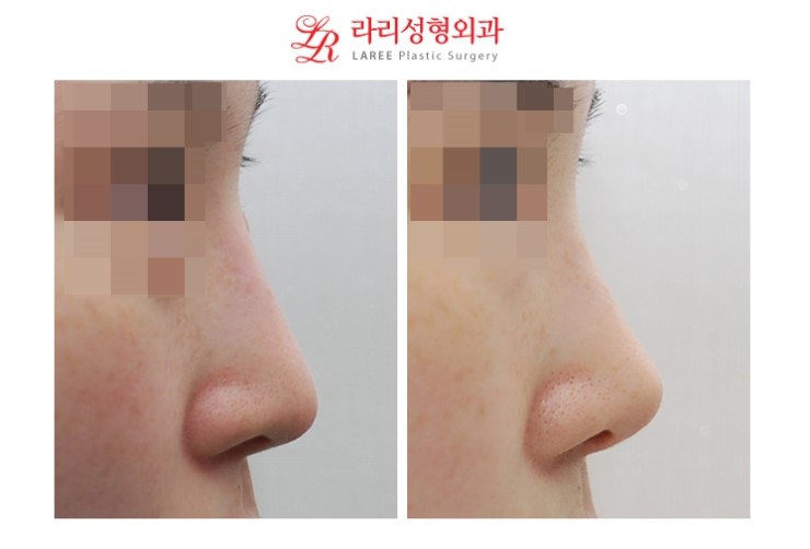 Revision Rhinoplasty for a Drooping Nose & Revision Surgery for a Drooping Nasal Tip
Long Nose & Long Nasal Tip Revision Surgery Before-and-After Photos image 4