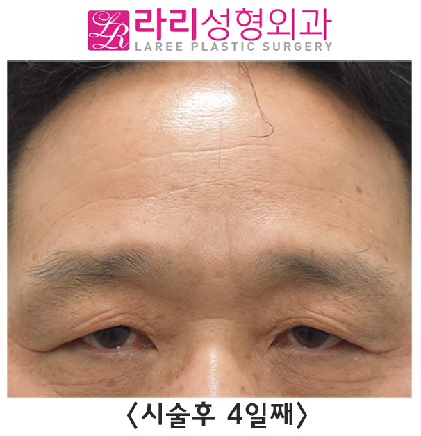 [라리성형외과] 이마 보톡스 효과 전후 사진 이마주름 얼마나 좋아지나 관련 이미지 6