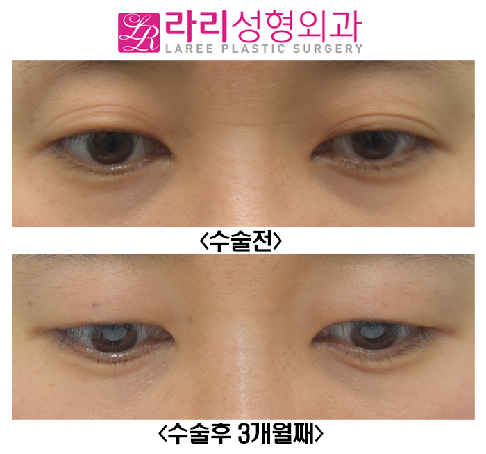 [라리성형외과] 윗눈꺼풀 주름 같은 애매한 쌍꺼풀 무쌍 만드는 수술 관련 이미지 5