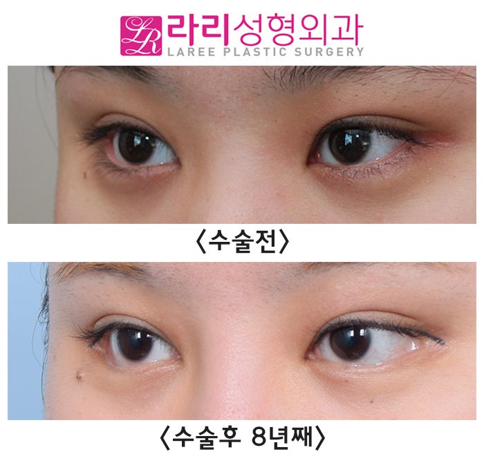 [라리성형외과] 단기 경과에 이은 뒤트임수술 8년 장기 경과 수술 전후 사진 관련 이미지 1