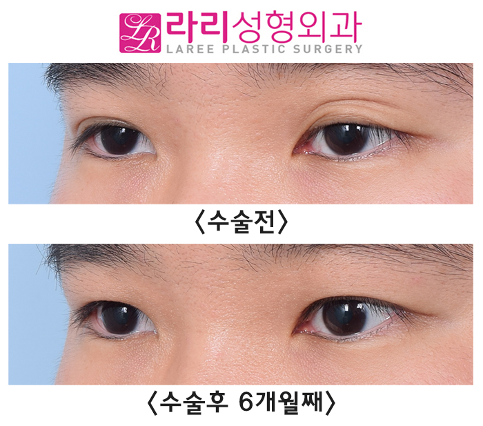 [Lari Plastic Surgery] Correcting a Severe Uneven Eye with Double Eyelid Removal Surgery image 3