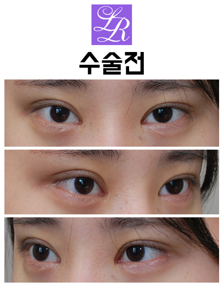듀얼트임? 뒷트임? 밑트임? 수술 효과 및 재발가능성 관련 이미지 2