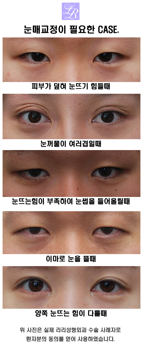 안검하수 눈매교정술 해야하는 경우 관련 이미지 3