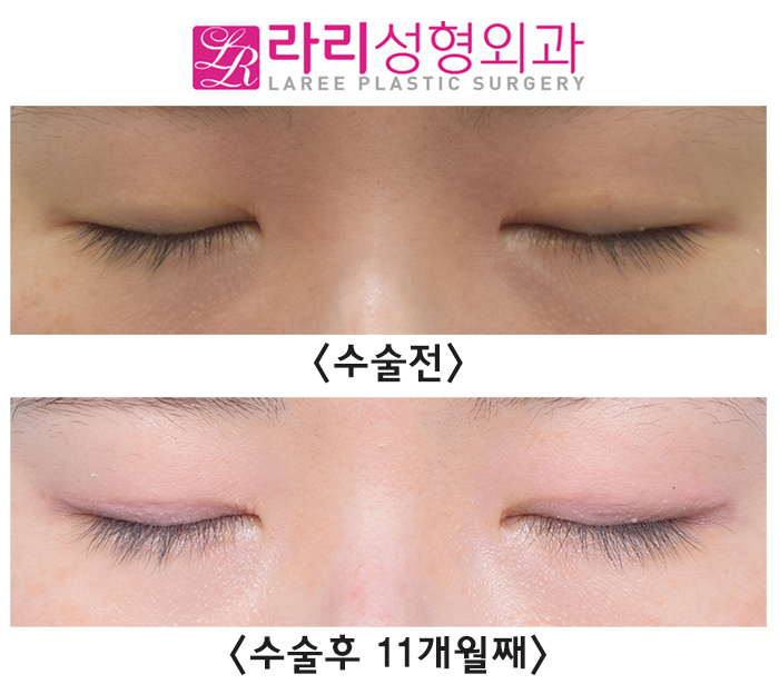 [라리성형외과] 지겨운 소세지 쌍꺼풀 싫어요, 자연스러운 속쌍 쌍꺼풀재수술 관련 이미지 2