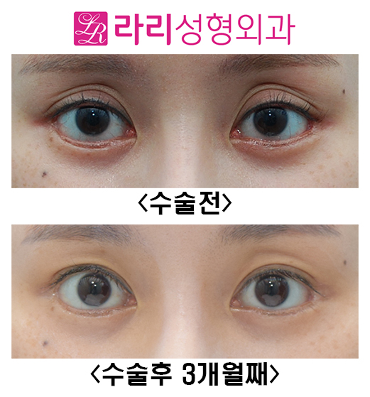 [라리성형외과] 쌍꺼풀재수술 눈두덩이 sunken 교정 관련 이미지 1