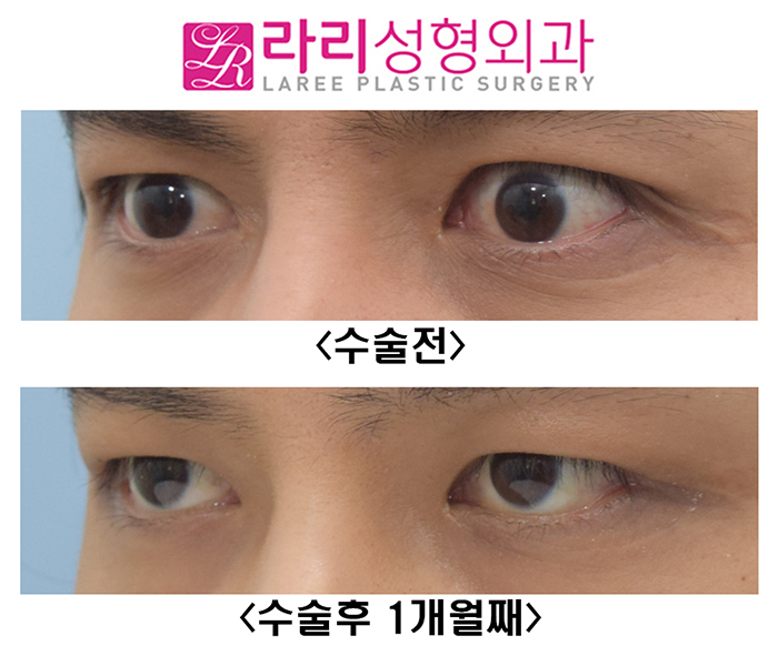 [라리성형외과] 눈크기 짝짝이 교정 수술 전후사진 관련 이미지 3