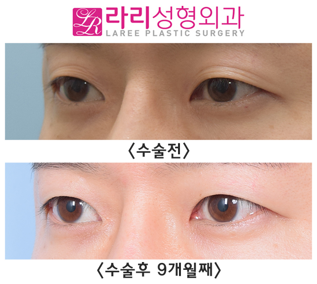 [라리성형외과] 무쌍으로 쌍꺼풀까지 없애는 절개눈매교정 관련 이미지 3