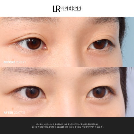 [라리성형외과] 쌍꺼풀수술 전후 사진으로 보는 눈매교정의 중요성 관련 이미지 2