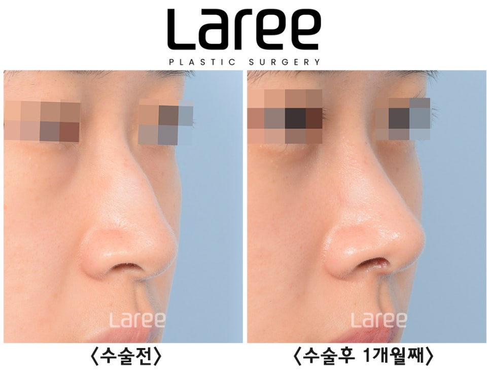 [Lari Plastic Surgery] Hump Nose Surgery Is Performed Naturally Without Implants. (No Implants, Septal Cartilage) image 3