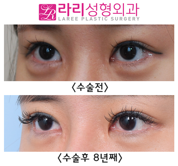 [Lari Plastic Surgery] Canthoplasty Reoperation for Lowering the Outer Corner of the Eyes: Before-and-After Photos Over More Than 8 Years of Long-Term Follow-Up image 2
