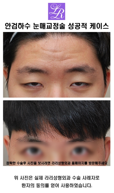 What Should You Check Before and After Male Eye Shape Correction? image 7