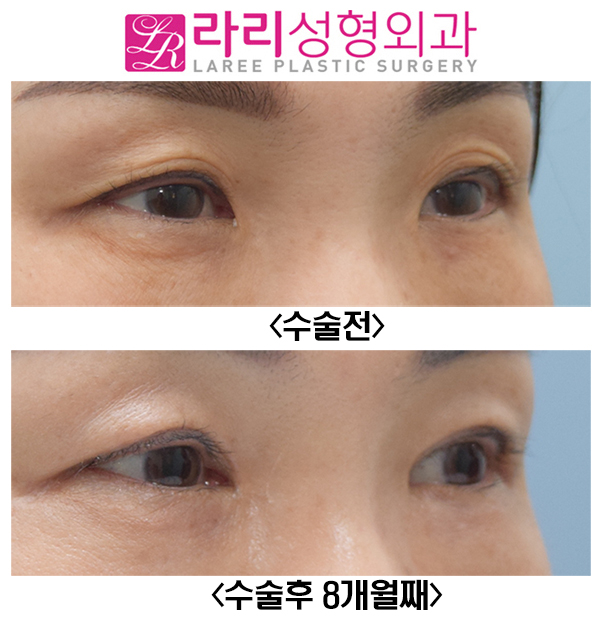 [라리성형외과] 여자도 하는 쌍꺼풀없애는수술, 앞트임수술과 찰떡 관련 이미지 3