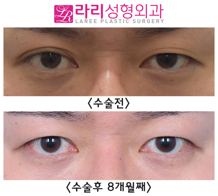 [Lari Plastic Surgery] Double Eyelid Removal Surgery That Completely Removes the Double Eyelid Line image 1