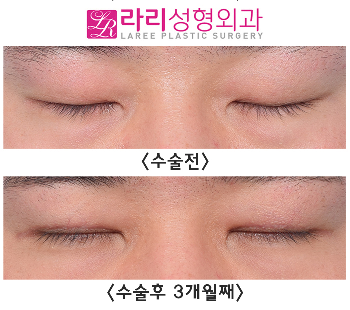 [라리성형외과] 이마미간 보톡스 그리고 절개 눈매교정 수술 전후 사진 단기 경과 관련 이미지 4
