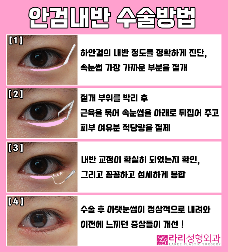 [라리성형외과] 안검내반과 안검외반, 무엇이 다를까 ? 관련 이미지 6