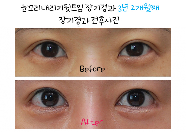 눈꼬리내리기뒤트임/뒷트임 장기경과 후기 효과가 확실하네~☆ 관련 이미지 5