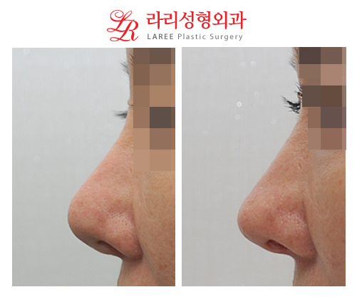 Before-and-After Photos of Revision Rhinoplasty for a Bulky, Upturned Nose-☆ image 1