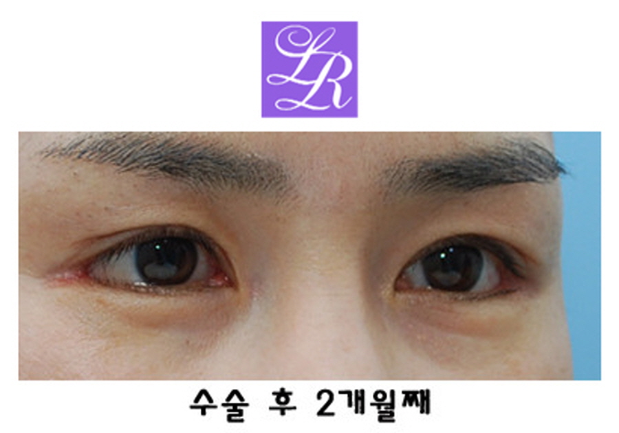 짝눈교정방법 중(쌍꺼풀재수술 + 눈매교정) 확인해야 될 사항 관련 이미지 6