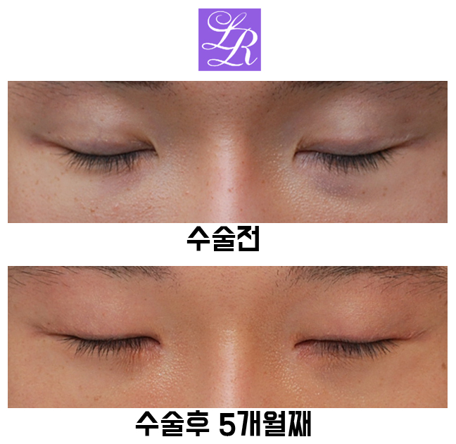 Review of Double Eyelid Removal Surgery + Epicanthic Fold Hook Removal Inner Corner Surgery image 3