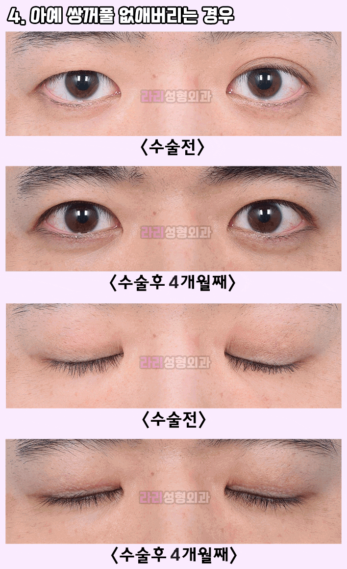 [라리성형외과] 쌍수후짝눈,  선천성짝눈 - 짝짝이쌍꺼풀의 비대칭 교정을 위한 눈성형 방법 관련 이미지 4