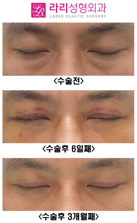 [라리성형외과] 쌍꺼풀없애기와 눈밑지방재배치수술 전후사진 관련 이미지 3
