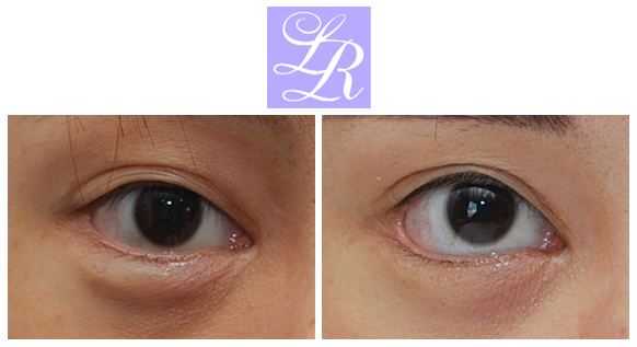 If You Want an S-Line Under Your Eyes, Try Lower Eye Widening image 7
