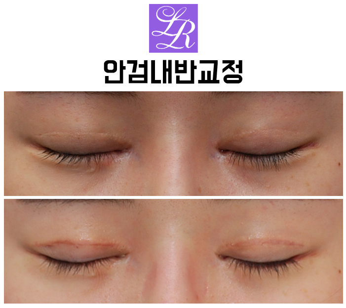 Can Lower-Eyelid Surgery and Entropion Correction Be Done at the Same Time? image 2
