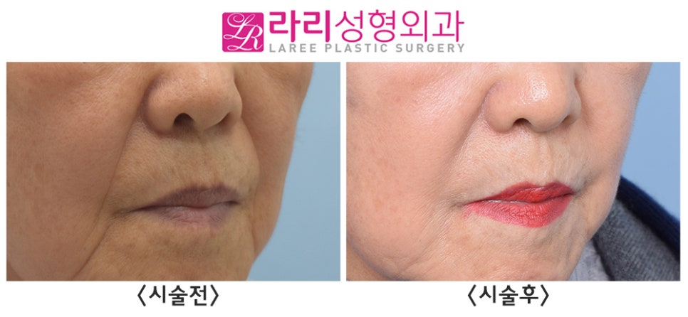 [라리성형외과] 거상수술 없이 필러시술로 팔자주름(+마리오네트주름) 펴주기 (사진 有) 관련 이미지 3