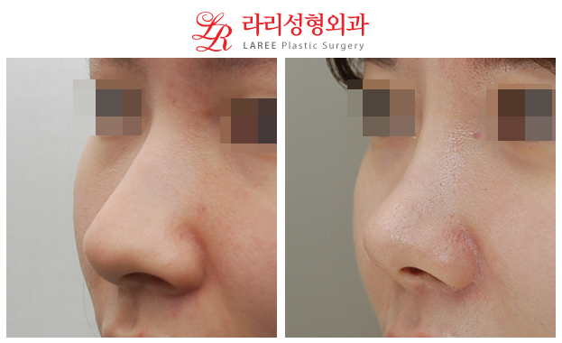 [Lari Plastic Surgery] Nose Surgery / Alar Reduction 4-Year Long-Term Follow-Up Before-and-After Photos image 4