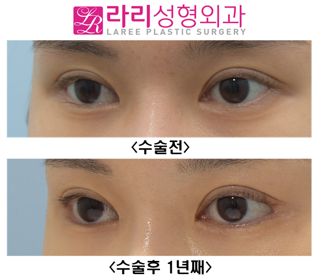 [라리성형외과] 뒤트임수술 첫 수술에 효과적으로 성공하기 관련 이미지 3