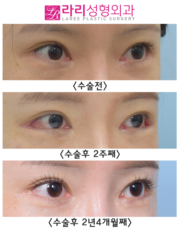 [라리성형외과] 뒷트임수술(재수술, 재재수술) 회복 기간 중이라면 걱정하지 말자 관련 이미지 1