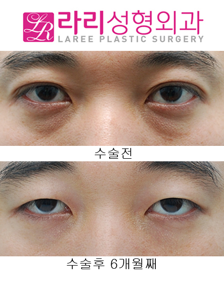 [Lari Plastic Surgery] Removing Double Eyelids After Multiple Buried Double-Eyelid Surgeries image 1