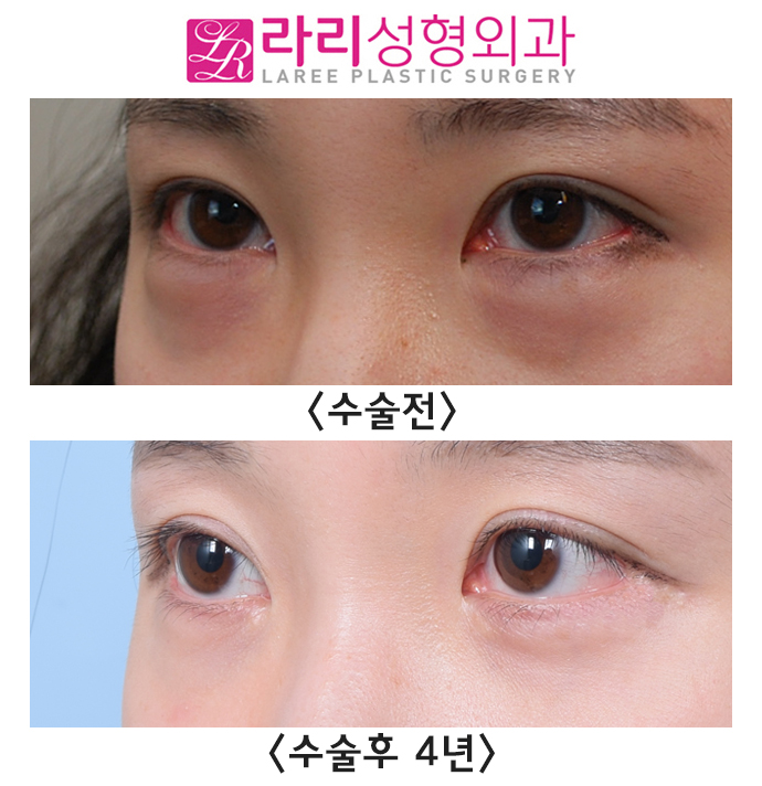 [라리성형외과] 뒤트임 부작용? 빨간살(결막노출) -재수술로 교정 관련 이미지 3
