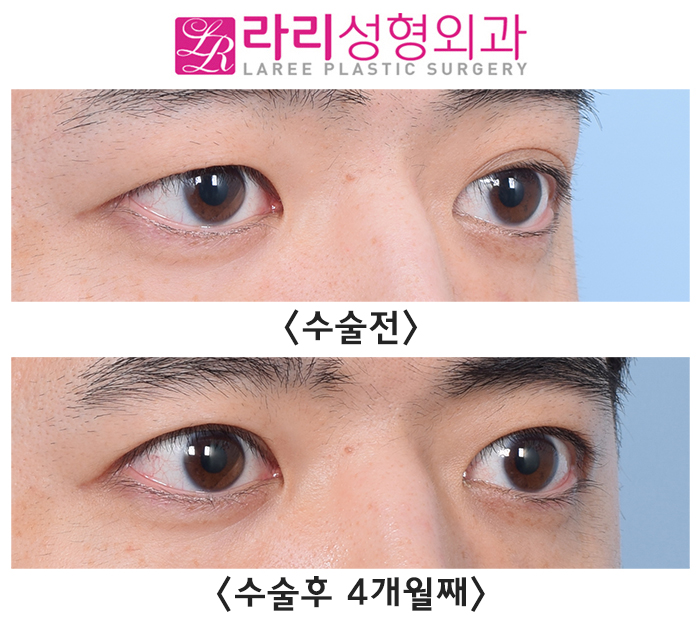 [라리성형외과] 교정과 예방을 모두 위한 쌍꺼풀없애기수술 전후 사진 관련 이미지 3