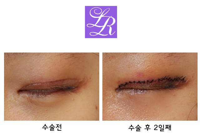 Upper Eyelid Double Eyelid Surgery, Eyelid Eversion (Mucosal Show, Eyelash Elevation) - Rapid Correction image 2