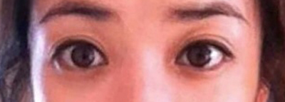 Long-Term Follow-Up Review Confirming the Effect of Lower Canthoplasty image 1