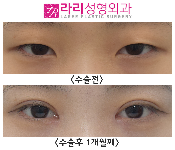 [라리성형외과] 쌍꺼풀 만드는 절개눈매교정과 앞트임수술 전후 관련 이미지 1