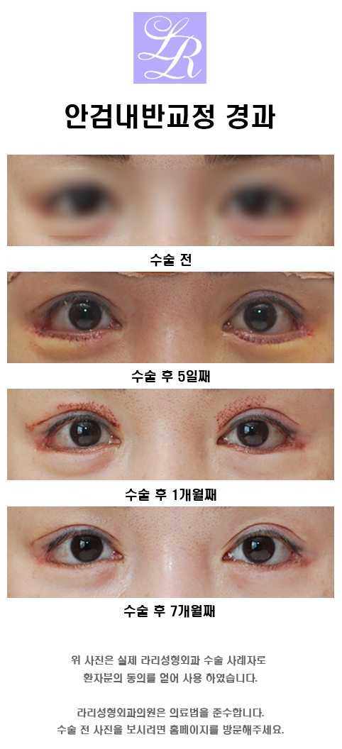 안검내반의 주증상은 속눈썹 찔림 - 수술 교정 관련 이미지 5